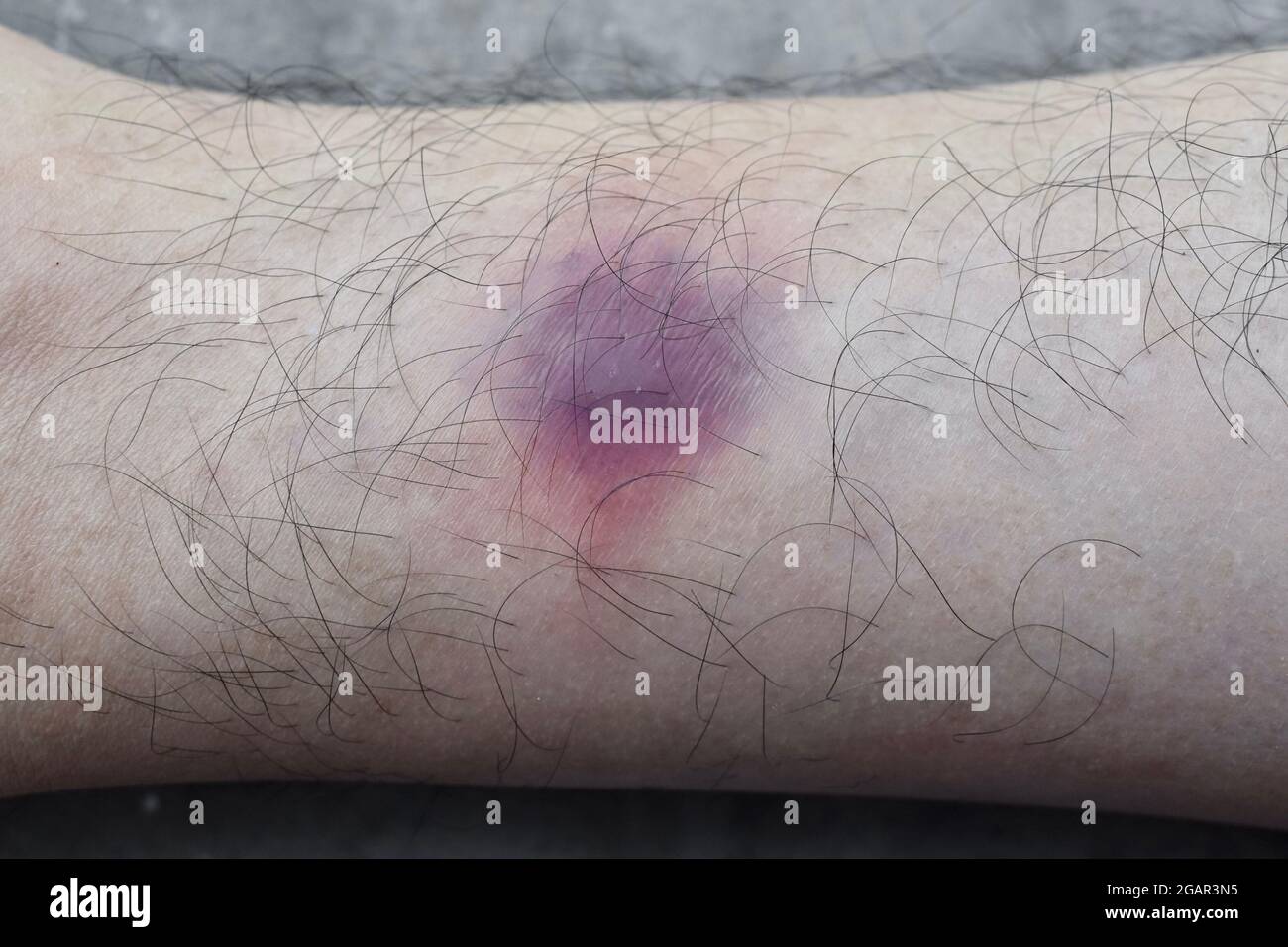 Schmerzhafter bluterguss Fotos und Bildmaterial in hoher Auflösung Alamy