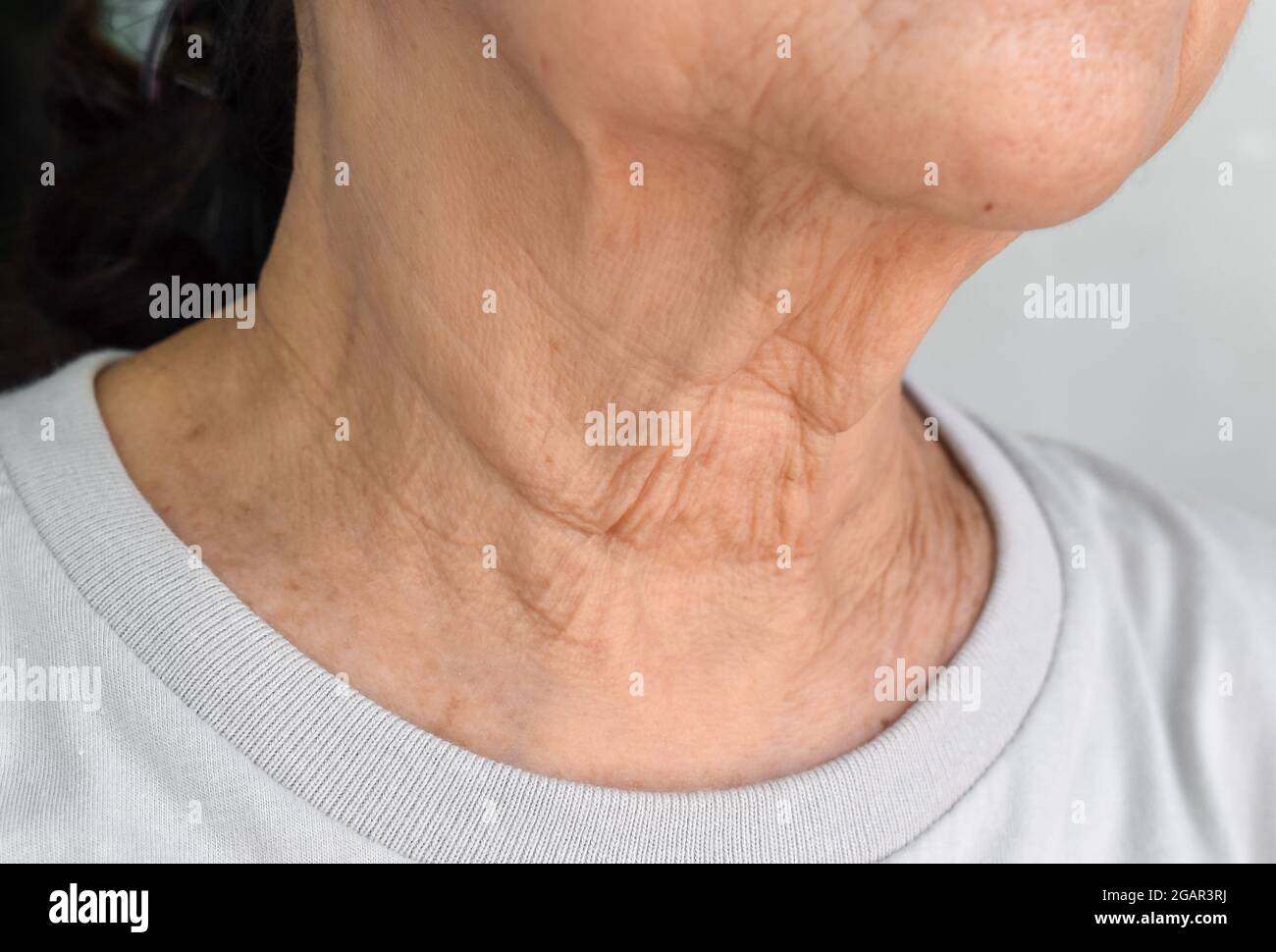 Alternde Hautfalten oder Hautfalten oder Falten am Hals südostasiatischer, älterer chinesischer Frau. Stockfoto