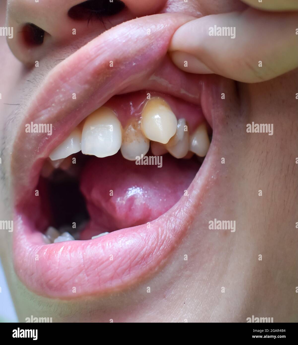 Malokklusion, Überfüllung der oberen Zähne einschließlich Eckzähne bei südostasiatischem, chinesischem jungen Mann. Stockfoto