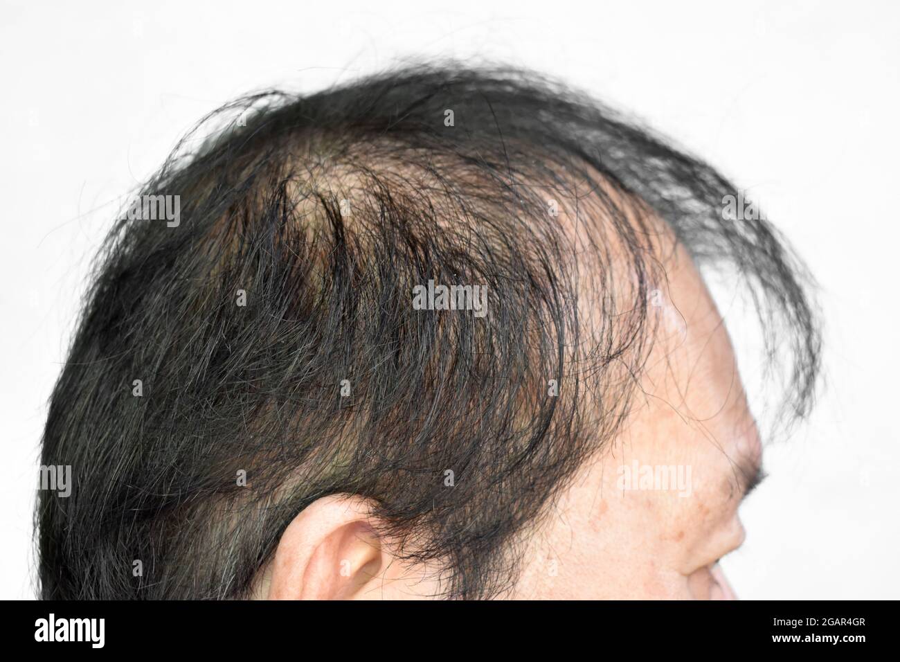 Dünner werdendes oder spärliches Haar, Haarausfall nach männlichem Muster im südostasiatischen, chinesischen älteren Mann. Isoliert auf Weiß. Stockfoto