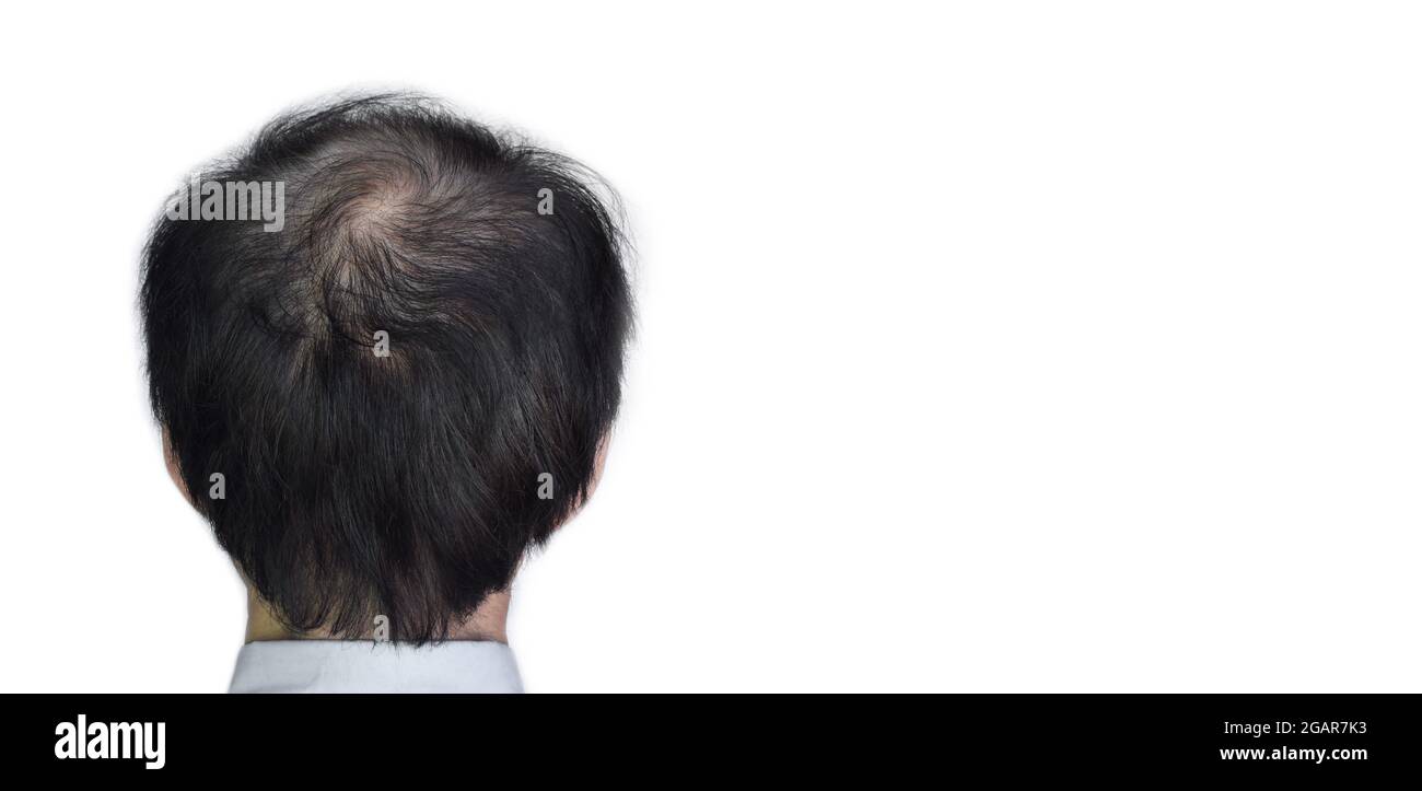 Dünner werdendes oder spärliches Haar, Haarausfall nach männlichem Muster im südostasiatischen, chinesischen älteren Mann. Mit Textbereich. Isoliert auf Weiß. Stockfoto