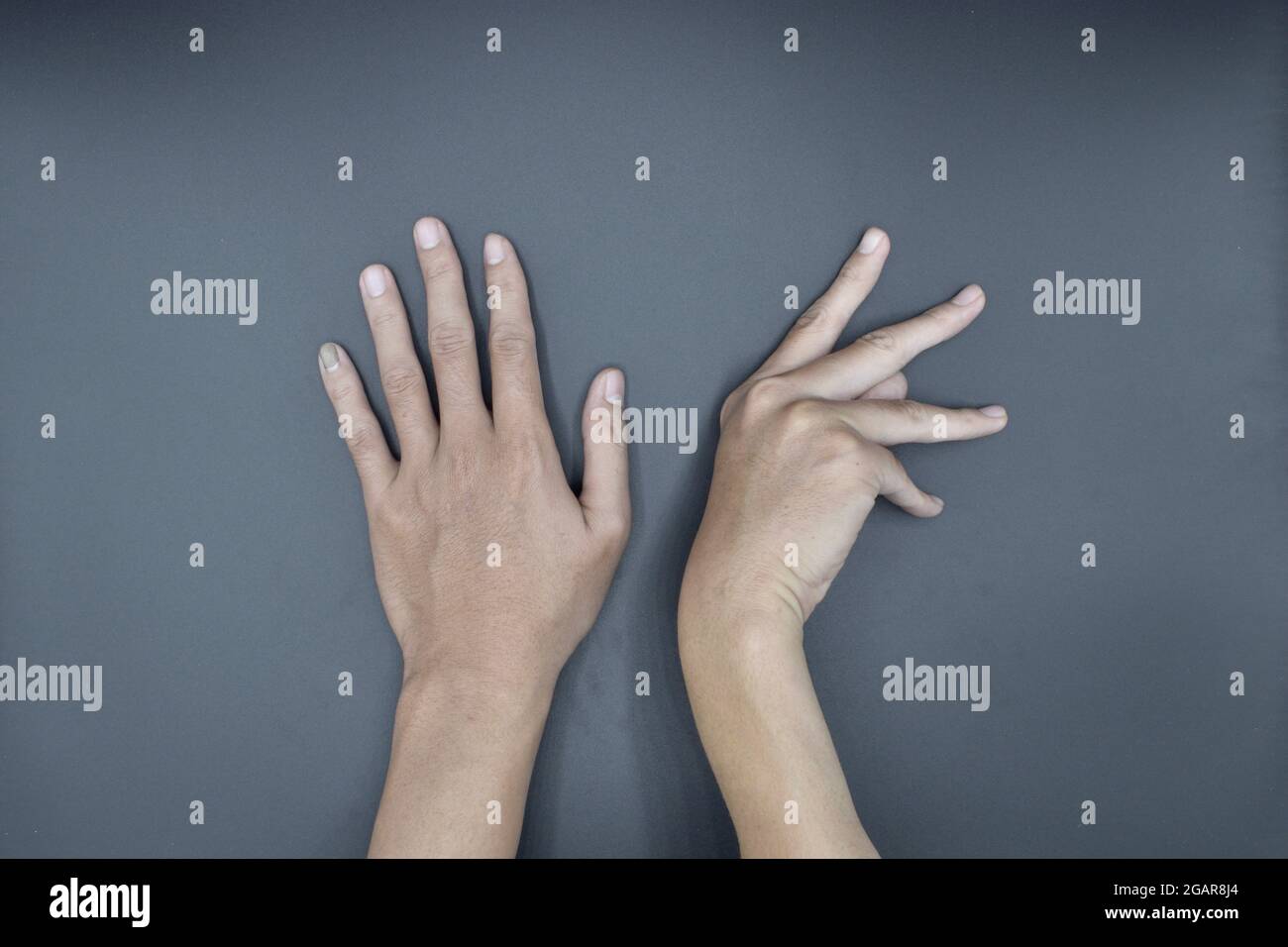 Einseitige Dupuytren-Kontraktur beim jungen asiatischen Mann. Einseitige Handdeformität. Anormale Beugung der Finger. Isoliert auf grauem Hintergrund. Stockfoto