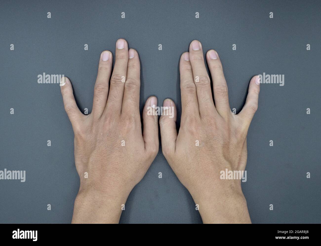 Bilaterale kleine Fingerabweichung beim asiatischen jungen Mann. Beidseitige Handverformungen. Anormale Verlängerung der Finger. Isoliert auf grauem Hintergrund. Stockfoto