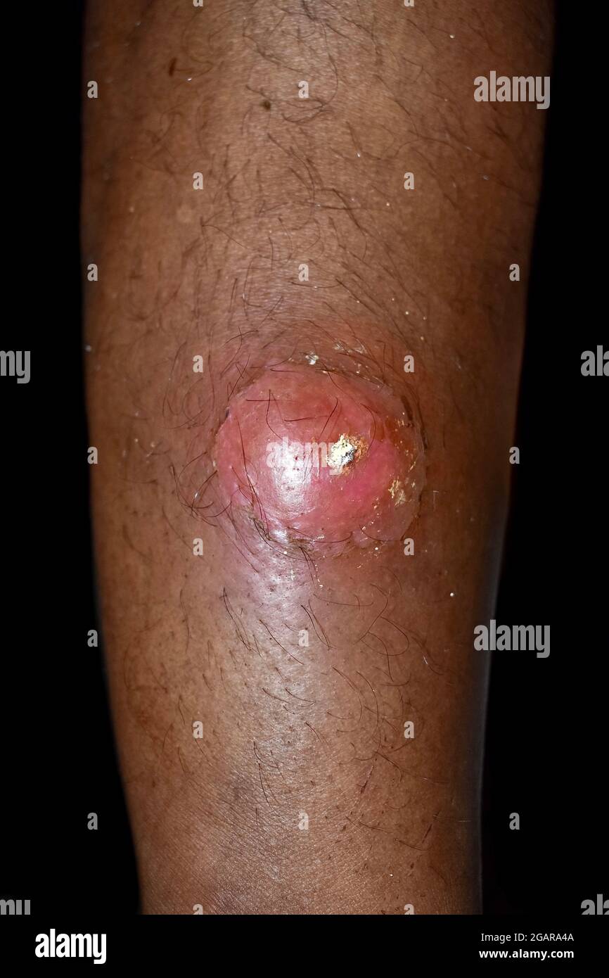 Drohender Abszess mit umgebender Cellulitis oder Staphylokokken-/Streptokokken-Hautinfektion am rechten Bein eines männlichen asiatischen Patienten aus Burma. Nahaufnahme vie Stockfoto