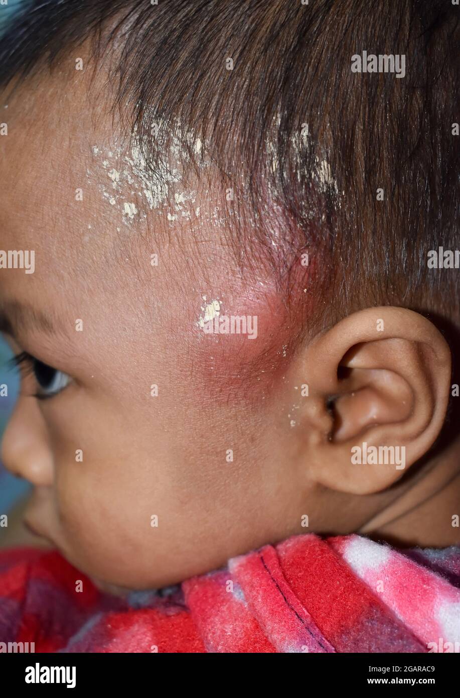 Schmerzhafte Karbunkel oder Cellulitis oder Staphylokokken / Streptokokken-Hautinfektion mit topischer traditioneller Medizin, die im Kopf von asiatischen Burmesen angewendet wird Stockfoto