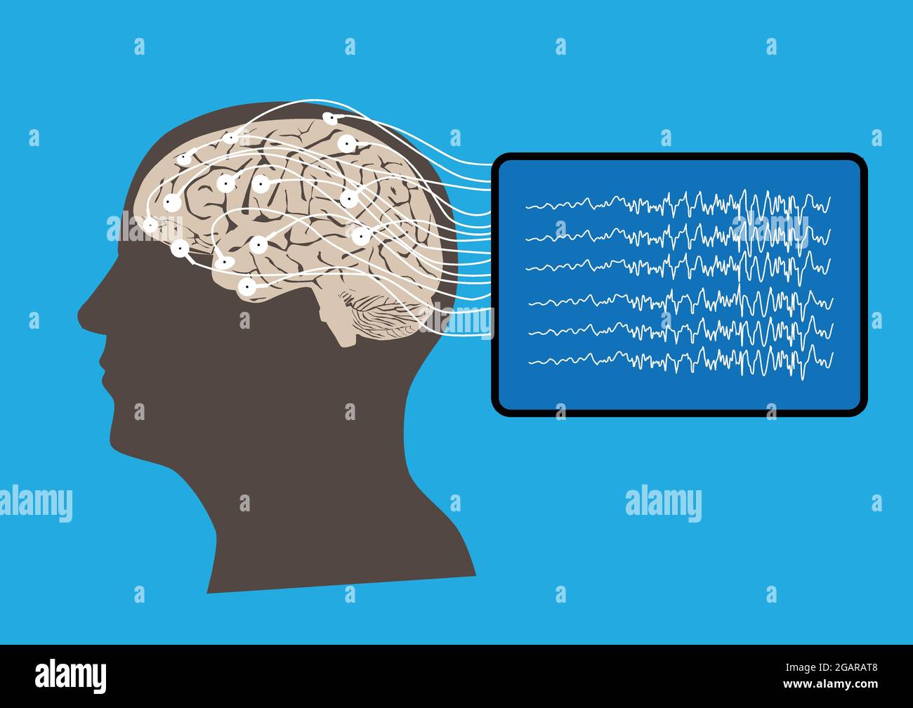 Illustration der menschlichen Gehirn- und Elektroenzephalographie oder EEG-Aufzeichnung und Gehirnwellen Stock Vektor