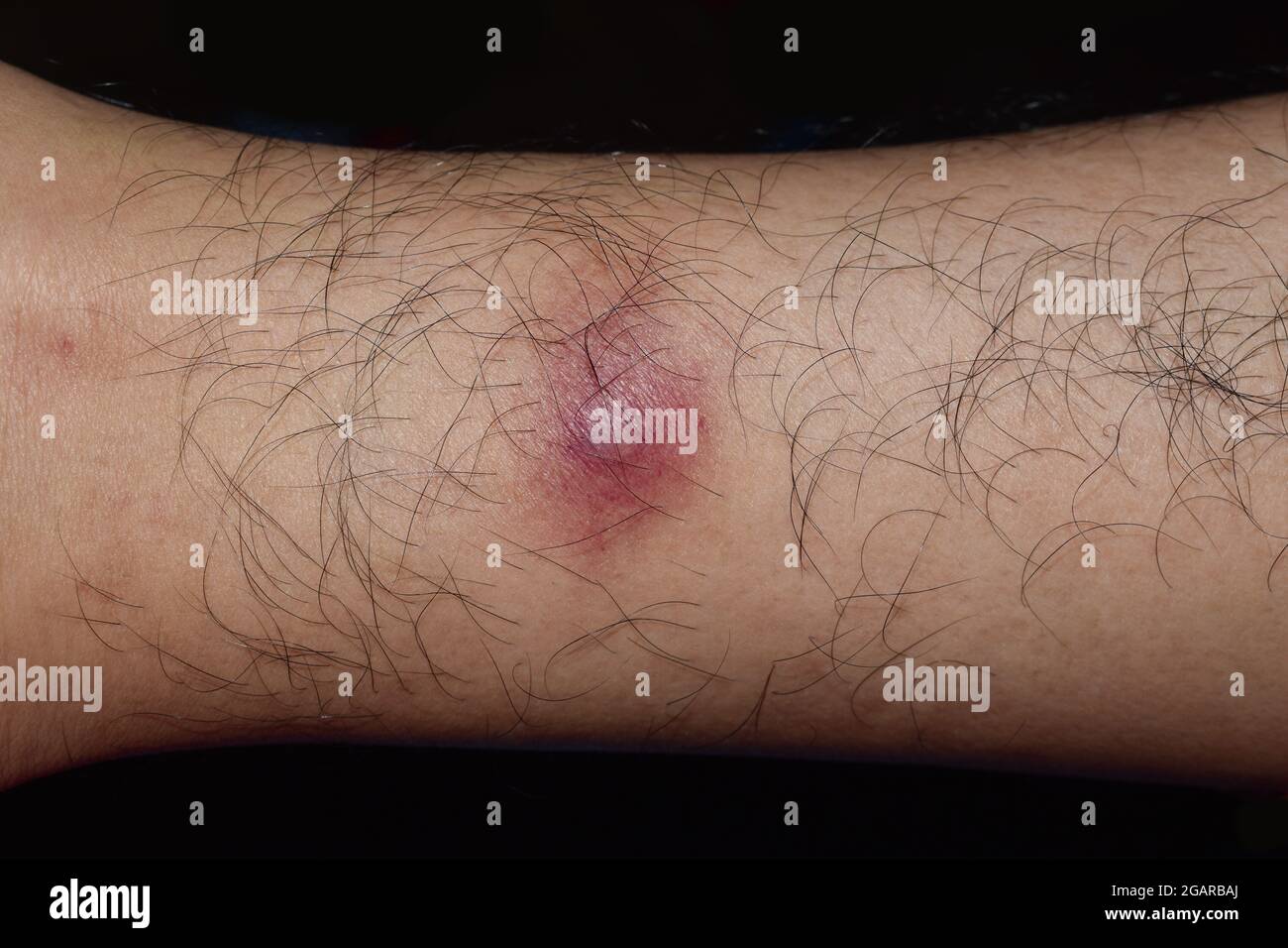 Cellulitis oder Staphylokokken-/Streptokokken-Hautinfektion am rechten Bein eines männlichen asiatischen Patienten aus Burma. Nahaufnahme. Stockfoto