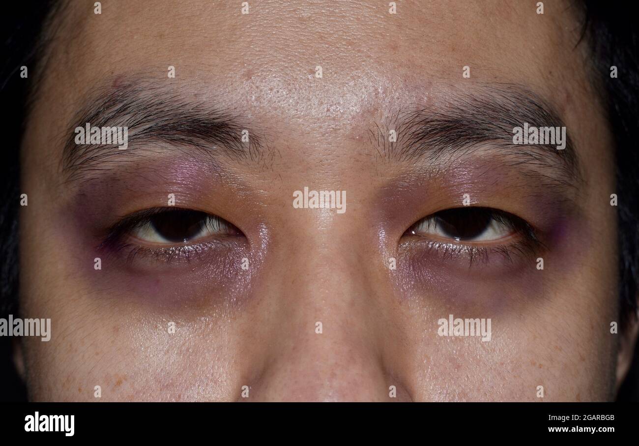 Raccon-Augen oder periorbitale Ekchymose oder Panda-Auge zeichnen sich bei einem jungen südostasiatischen Patienten aus. Es ist ein Zeichen für eine basale Schädelfraktur oder einen subgalischen Härat Stockfoto
