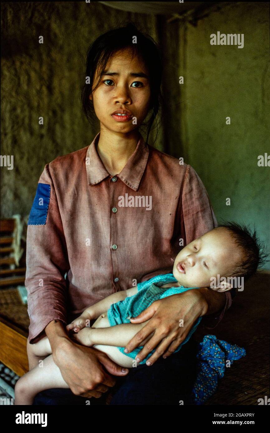 Pham Thi Huan, 24, mit ihrem ersten Kind, Bui Van Xuan, ist 20 Monate alt. Er kann weder sprechen, noch aufstehen und hat keine Augen. Sein Vater, Bui Van Tram, 28, ein Kriegsveteran, wurde dreimal mit Agent Orange besprüht. Juni 1980 Stockfoto