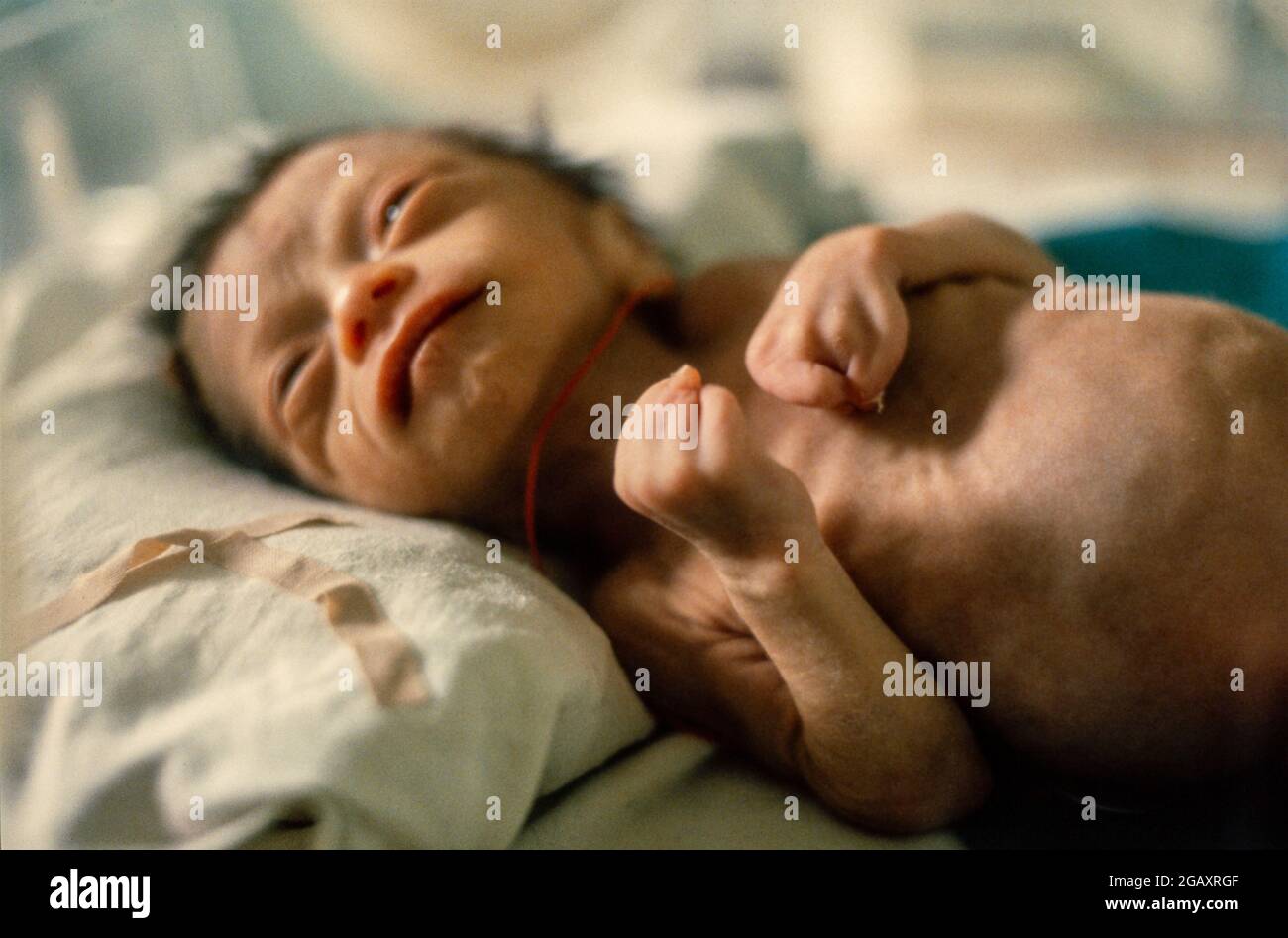 Pham Xuan Lo, geboren am 10. Juni 1980. Der Vater des Babys wurde von US-Kampfflugzeugen als Soldat im Süden mit Agent Orange besprüht. Dies ist das erste Kind der Familie. Dieses vorzeitige Baby hat eine innere und wird voraussichtlich nur noch eine Woche lang leben. Stockfoto