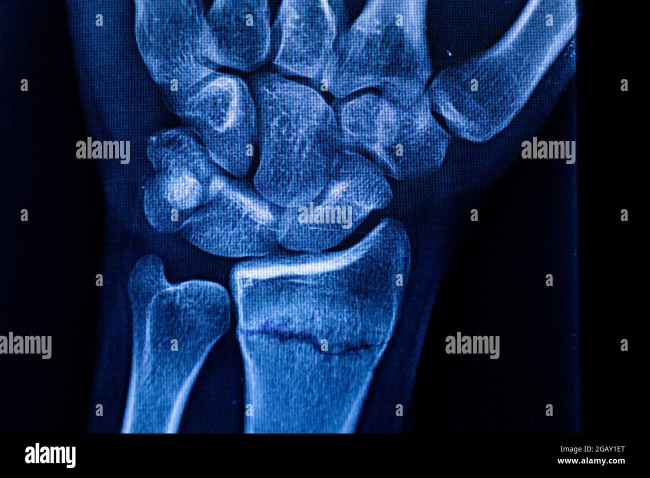 Radiographische Untersuchung der Radiusfraktur. Röntgen-Arm. Röntgenaufnahme von Handknochen. Medizintechnik-Radiographie. Röntgenfilm. Stockfoto