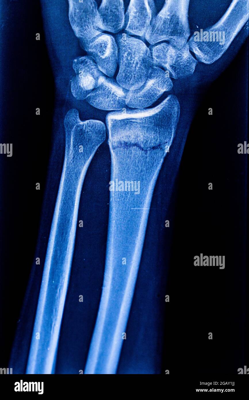 Radiographische Untersuchung der Radiusfraktur. Röntgen-Arm. Röntgenaufnahme von Handknochen. Medizintechnik-Radiographie. Röntgenfilm. Stockfoto
