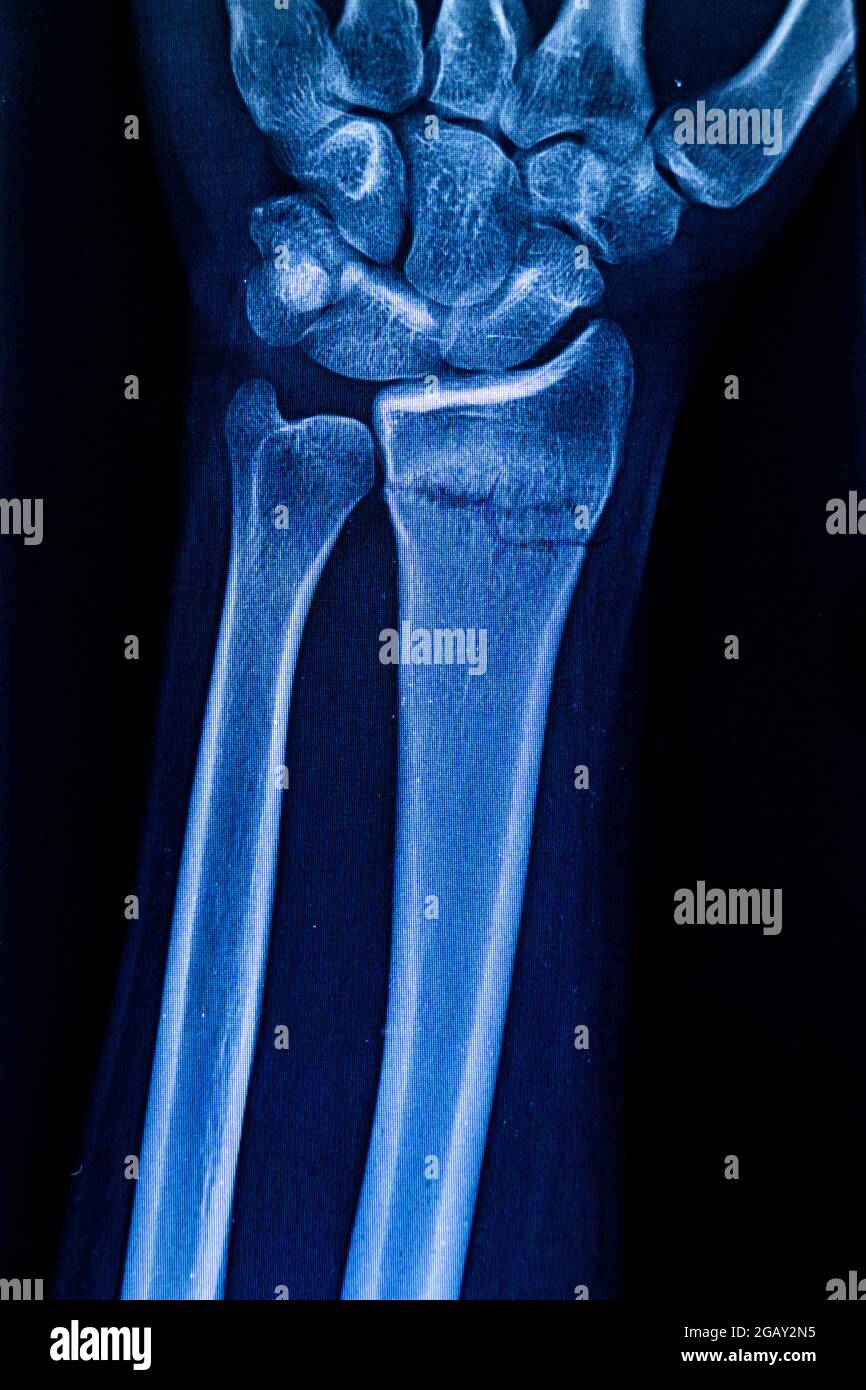 Radiographie zur Untersuchung eines Röntgenfilms des Arms des Patienten, der auf eine Radiusfraktur zeigt. Röntgenstrahlte menschliche Hand. Röntgenaufnahme von Handknochen. Medizintechnik-Radiographie Stockfoto
