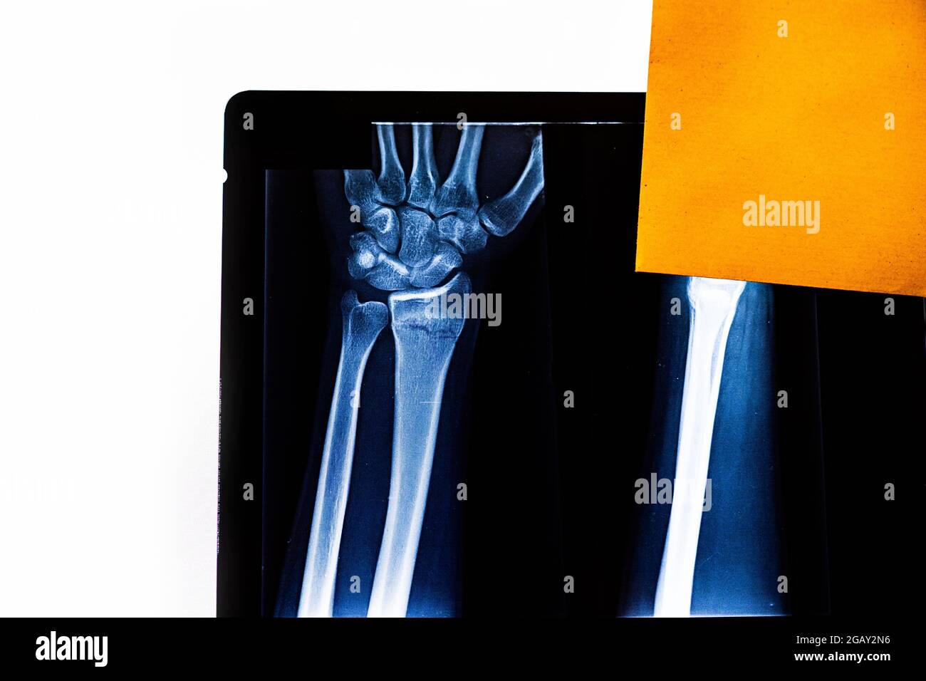 Untersuchung des Röntgenfilms des Arms des Patienten, der auf eine Radiusfraktur zeigt. Radiographie. Röntgenstrahlte menschliche Hand. Röntgenaufnahme von Handknochen. Röntgenaufnahme der Medizintechnik Stockfoto