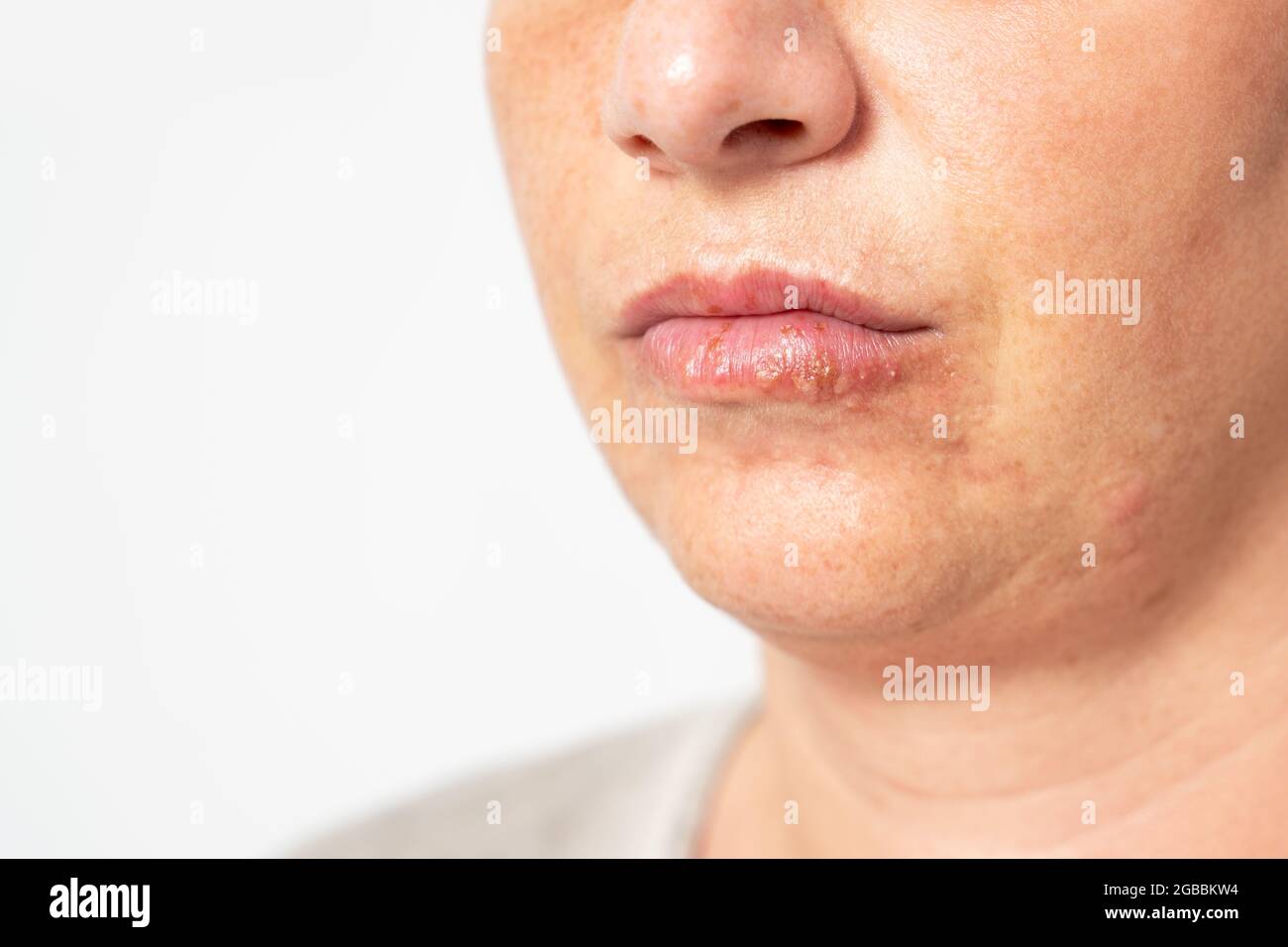 Junge Frau, die an Herpes auf ihren Lippen leidet. Konzept Hautproblem, Allergie und Dermatologie. Hochwertige Fotos Stockfoto