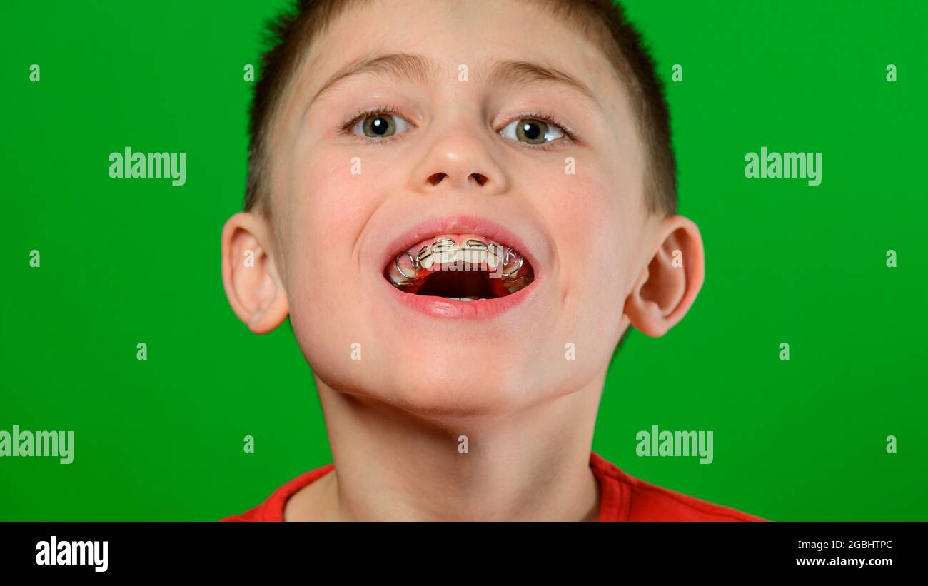 Ein Junge kaukasischer Nationalität zeigt eine Platte zum Richten schiefer und deformiger Zähne. Neu Stockfoto