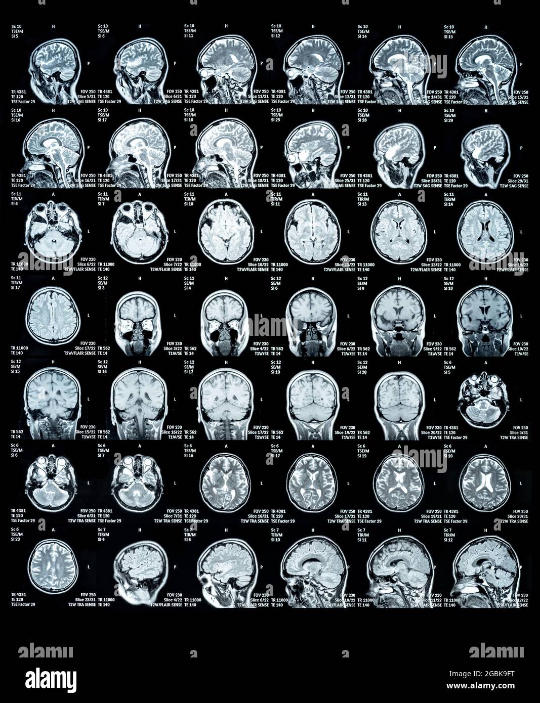 MRT Scan-Bild eines menschlichen Gehirns mit allen wichtigen Details der Multiplen Sklerose Stockfoto