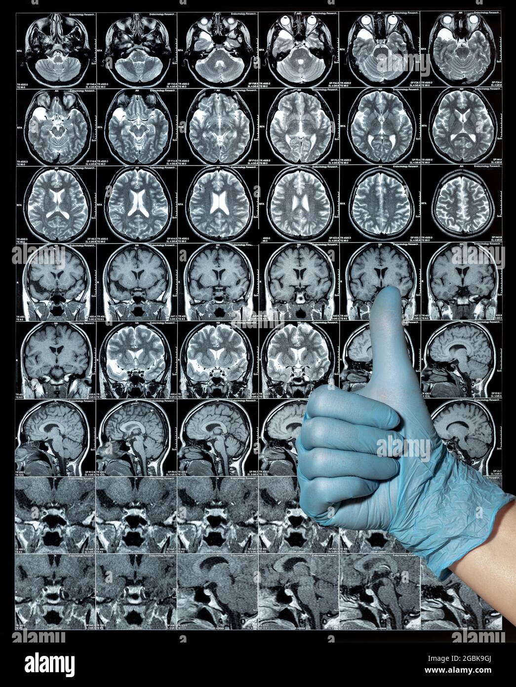 MRT-Hirnscan oder Magnetresonanzbildergebnisse, Neurologiekonzept, Daumen hoch Stockfoto