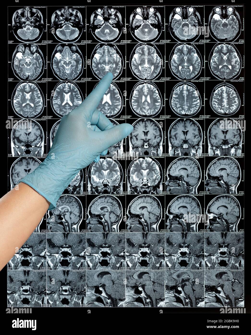 MRT-Hirnscan oder Magnetresonanzbild Ergebnisse, Neurologie zeigen einen Finger Stockfoto