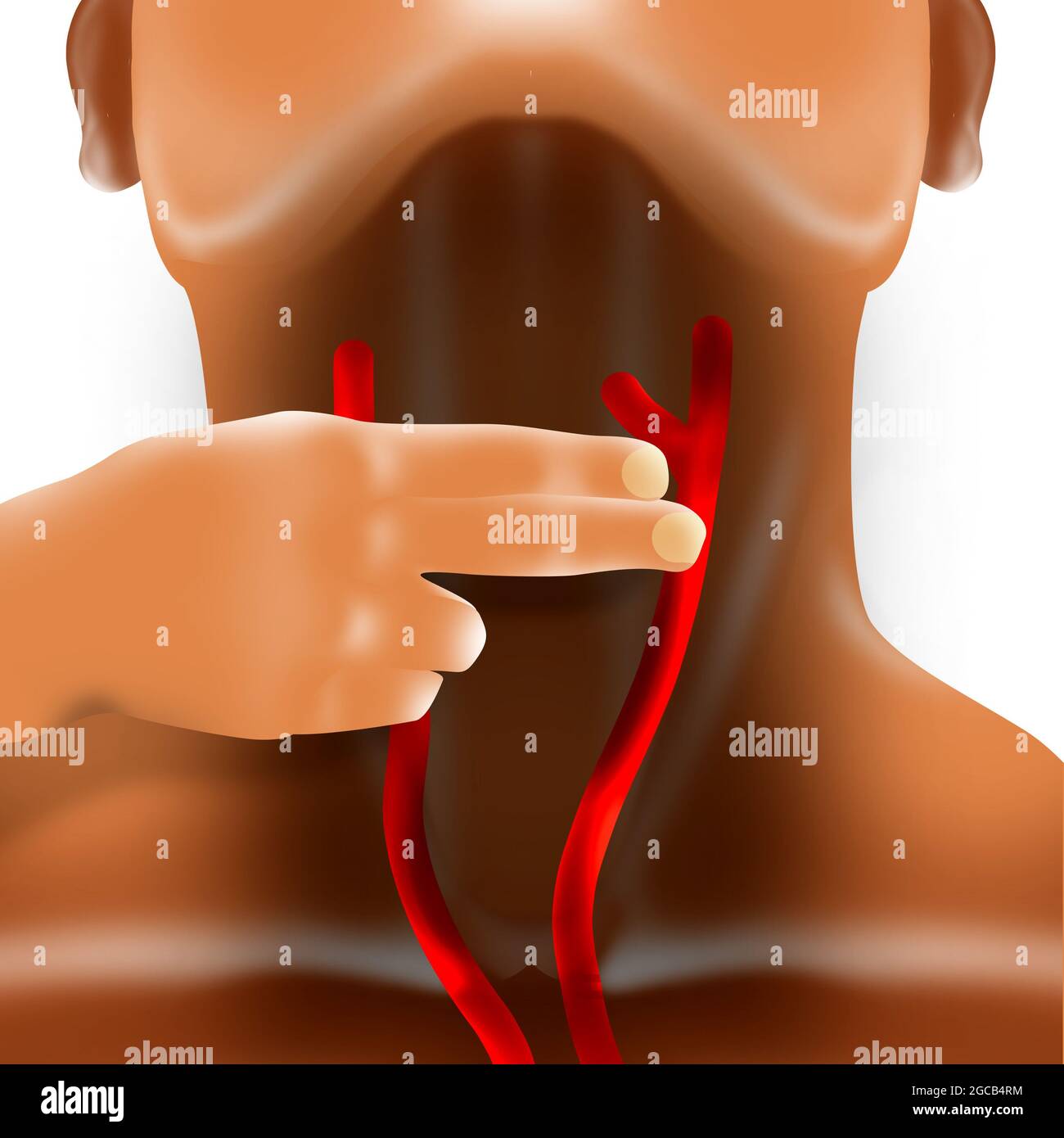 Sinusmassage der Karotis (CSM) Stockfoto