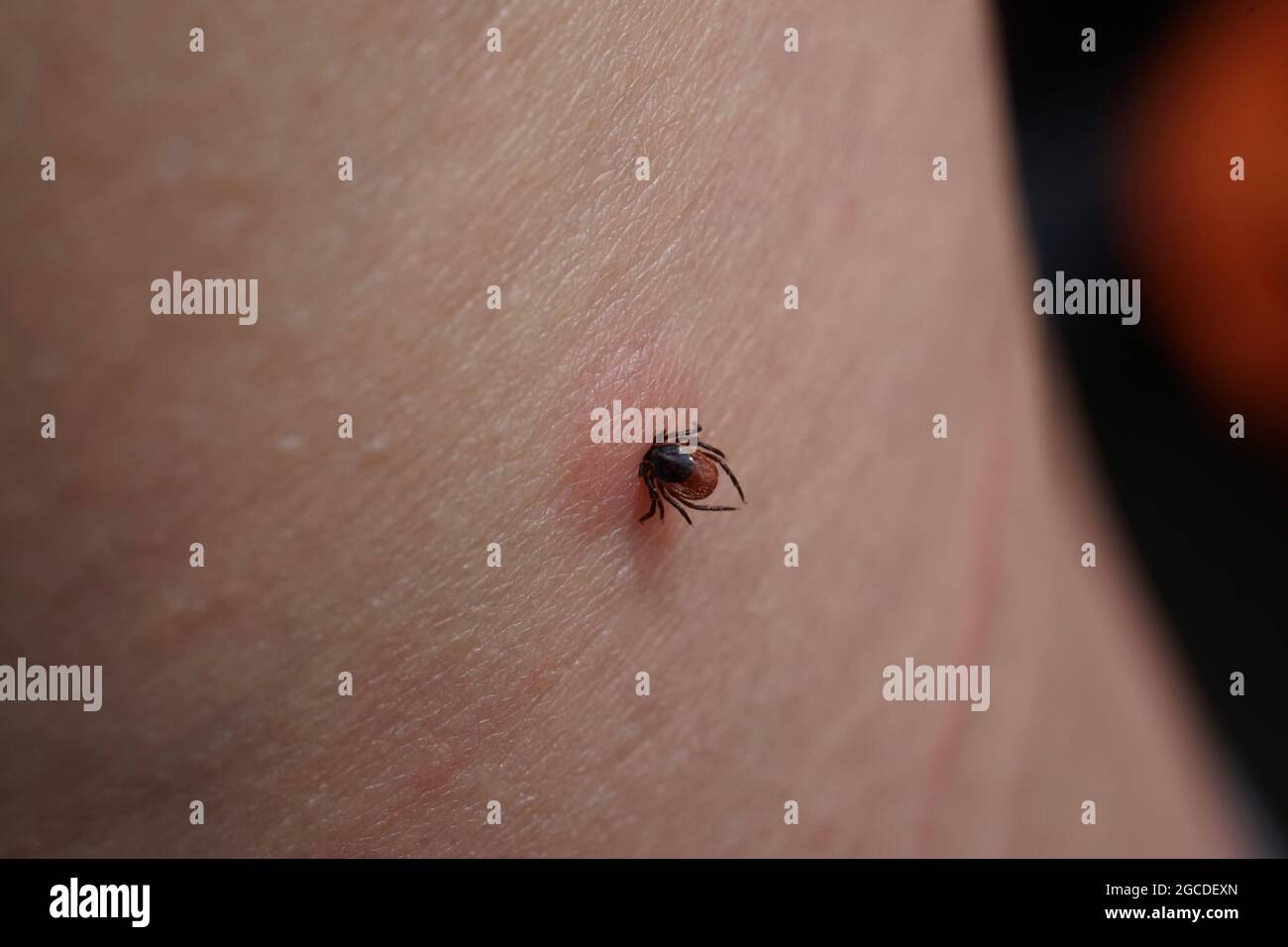 Nahaufnahme von saugen weibliche Zecke auf menschliche Haut, die reizt. Aufgeblähter Ixodes ricinus gefährlicher Parasit, der in rosa irritierte Epidermis beißt. Gefahr der Enk Stockfoto