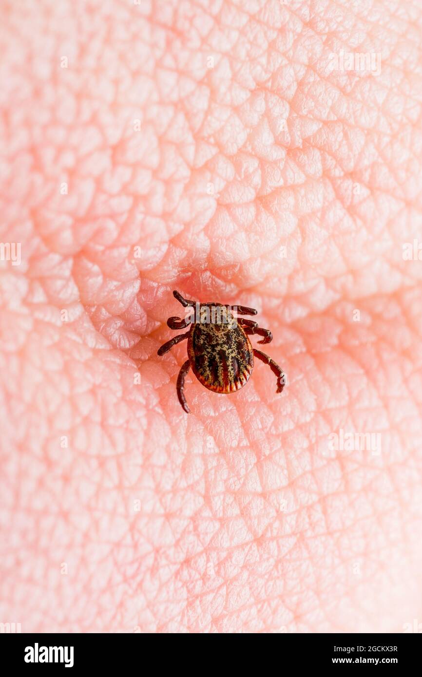 Infektiöse Encephalitis Zeckeninfekt auf der Haut. Encephalitis Virus oder Lyme-Borreliose infizierte Dermacentor Tick Arachnid Parasiten Biss Close-Up. Stockfoto