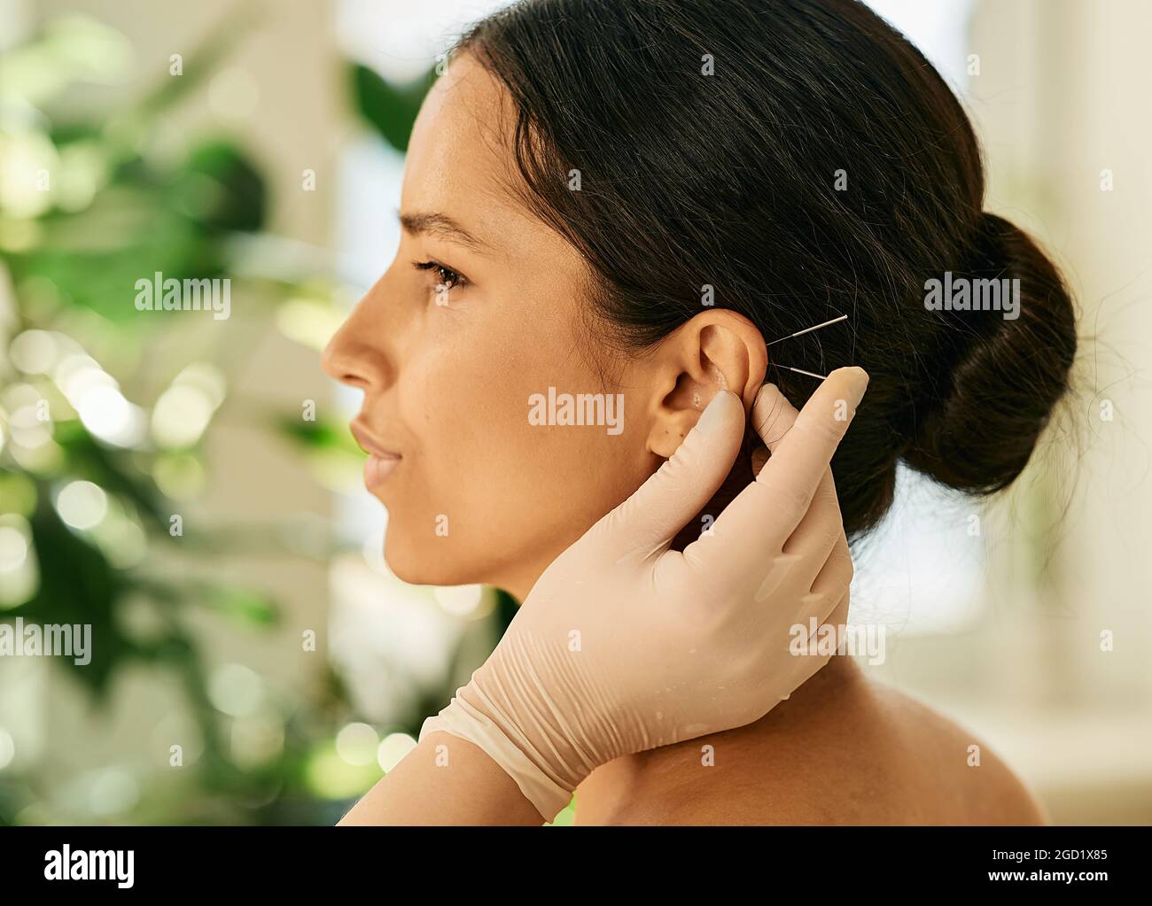 Frau mit Ohrakupruktur oder Ohrakupunktur für ihre Krankheiten Behandlung, Seitenansicht. Akupunktur, Reflexzonenmassage, traditionelle chinesische Medizin Stockfoto