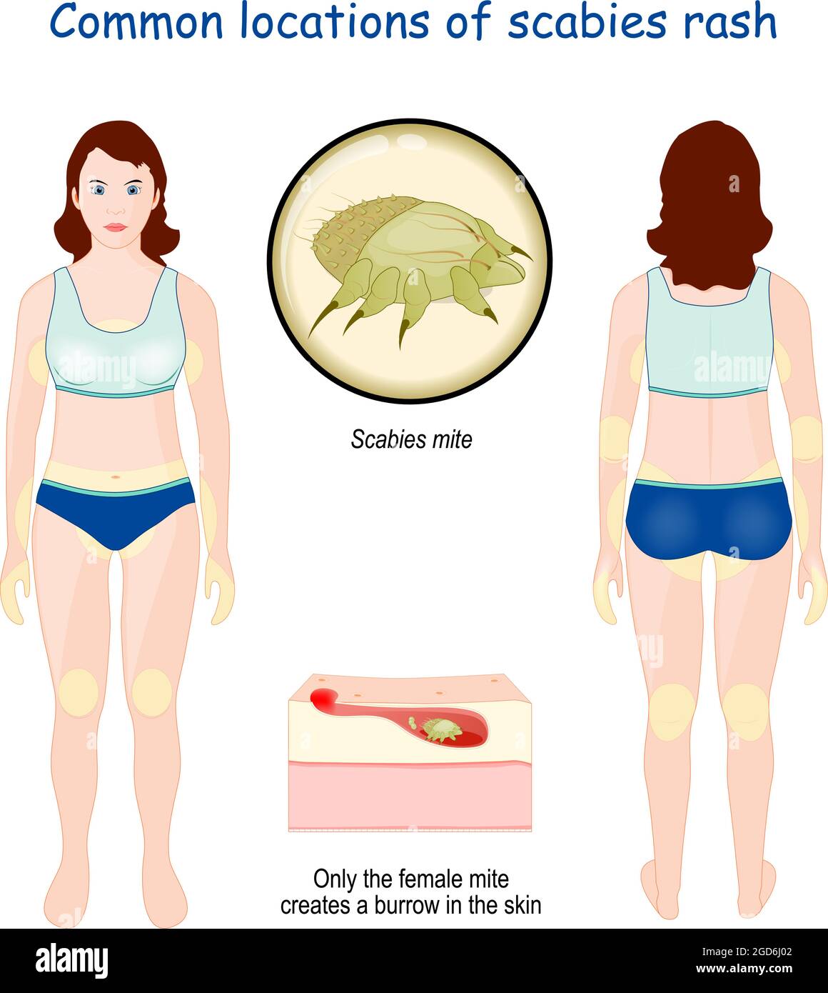 Häufige Standorte von Krätze Ausschlag. Nahaufnahme der Scabies Milbe. Vergrößerung des Querschnitts der Hautschichten Stock Vektor