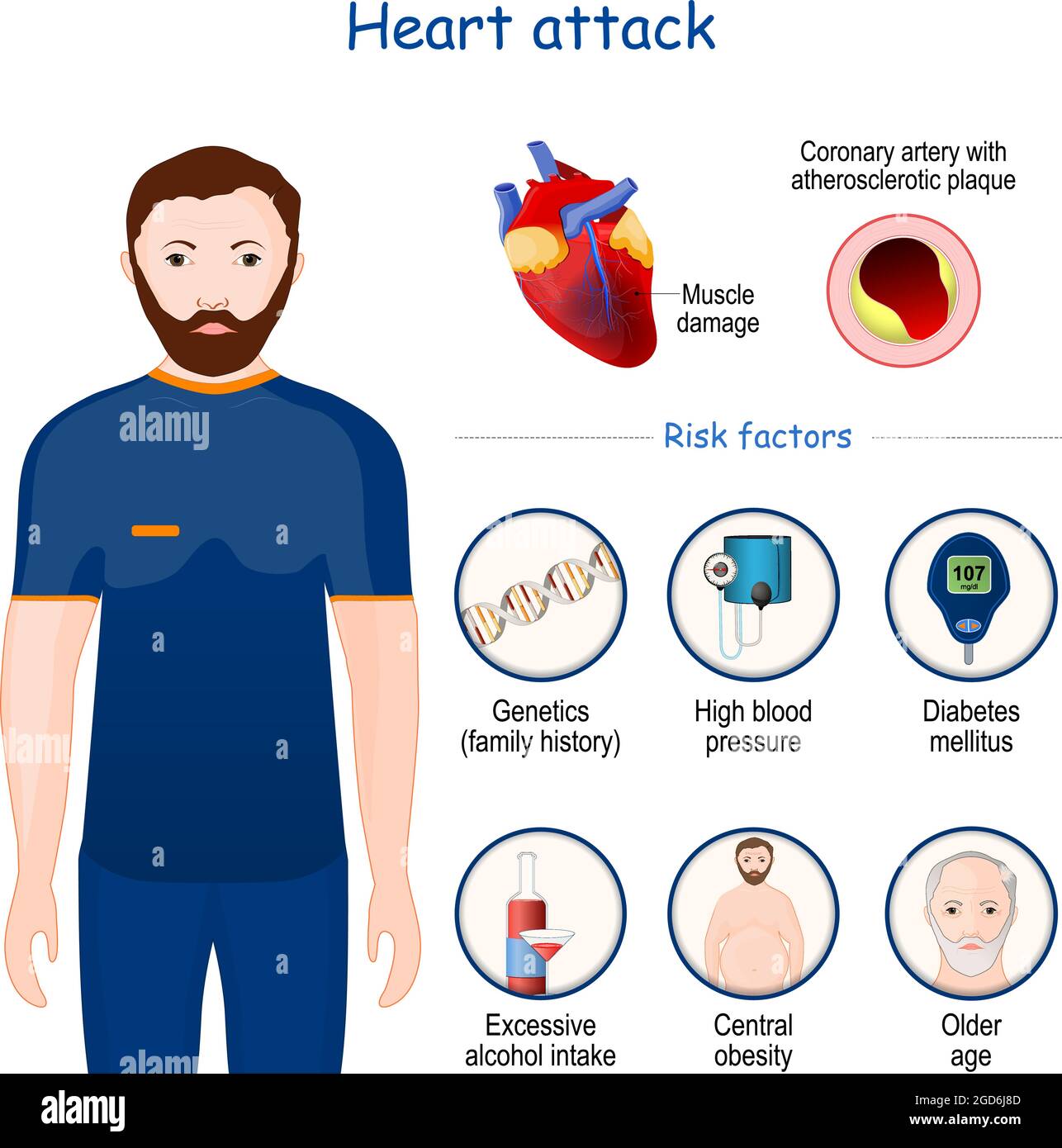 Herzinfarkt. Anzeichen, Symptome und Risikofaktoren. Infografik. Querschnitt der Koronararterie mit atherosklerotischer Plaque Stock Vektor