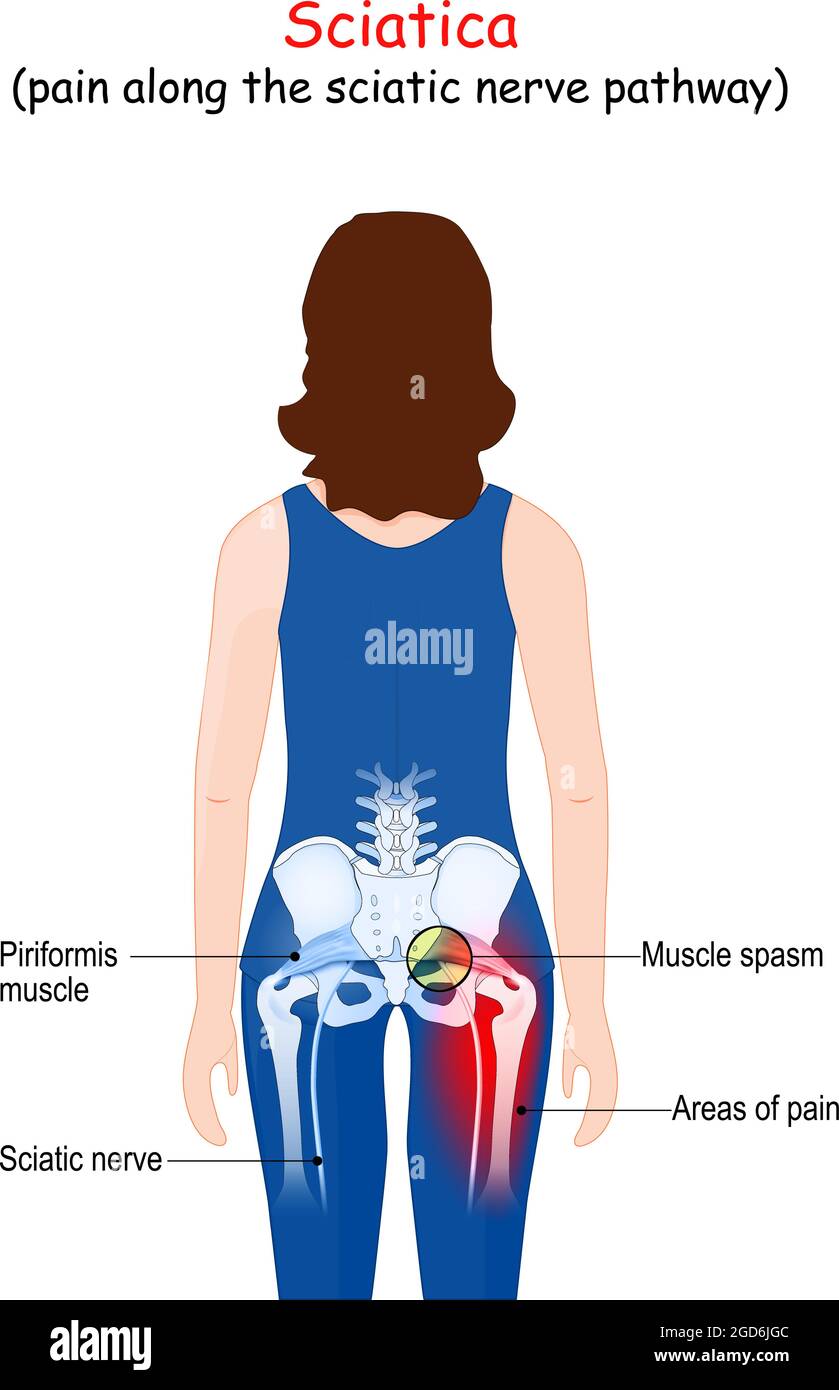 Ischias. Schmerzen entlang des Ischiasnervs vom unteren Rücken über die Hüfte bis zum Bein. Körper einer Patientin (Frau) mit Rückenschmerzen Stock Vektor