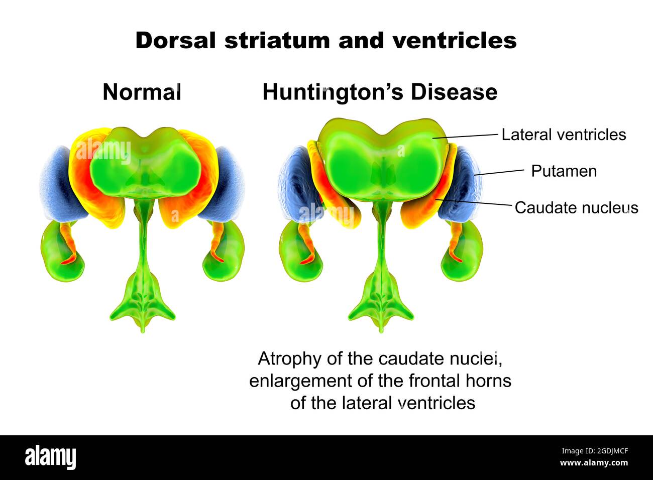 Dorsale Striatum und Ventrikel bei Morbus Huntington Stockfoto