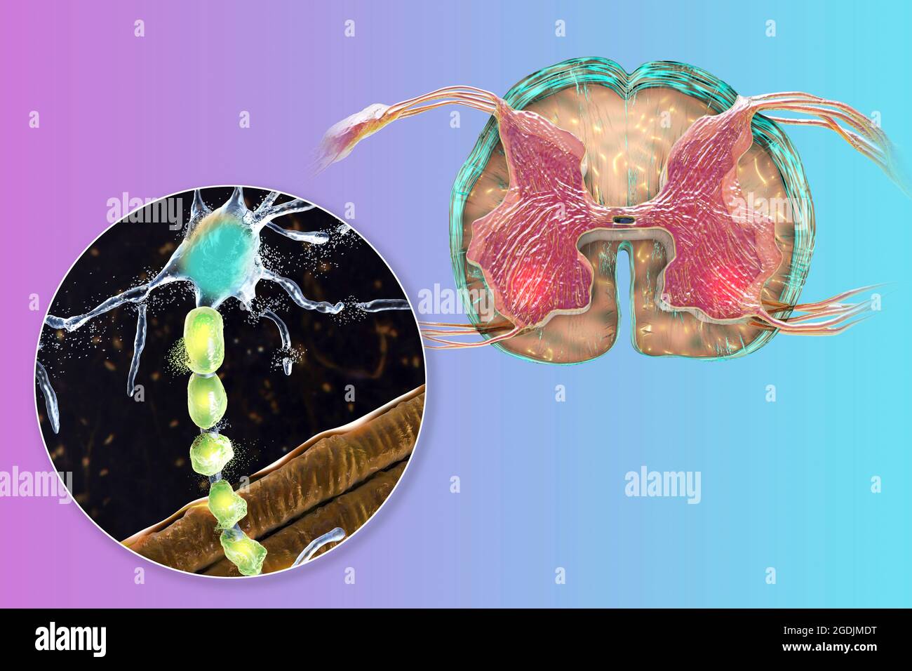 Erkrankungen der Motoneurone, Illustration Stockfoto