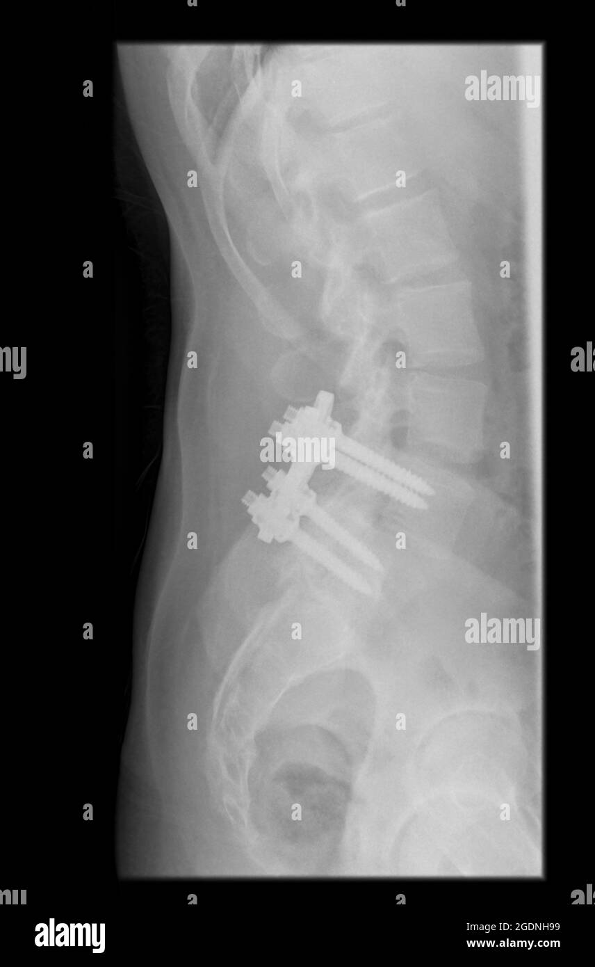 Röntgenaufnahme eines 31 Jahre alten Mannes mit Schrauben in L4 und L5 zur Linderung von Schmerzen im unteren Rücken Stockfoto