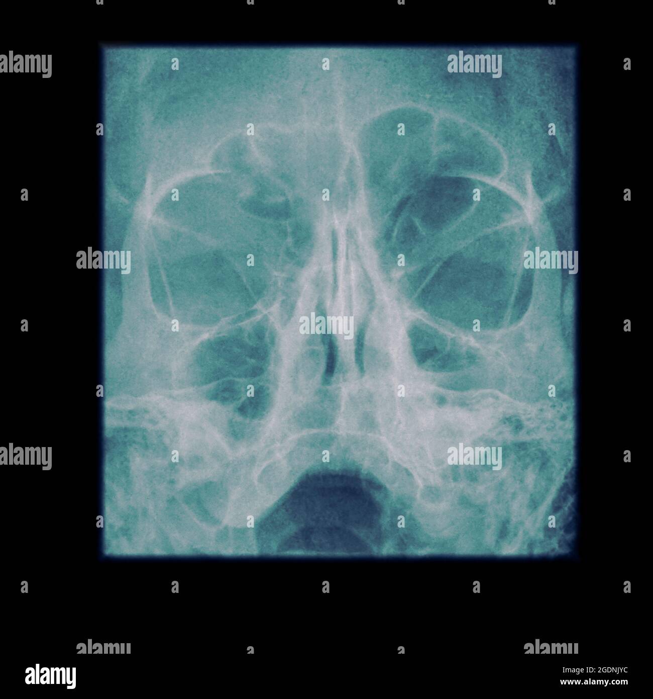 Ein 65-jähriger Mann, der an einer Sinusitis leidet. Röntgenaufnahme der Nasennebenhöhlen Stockfoto