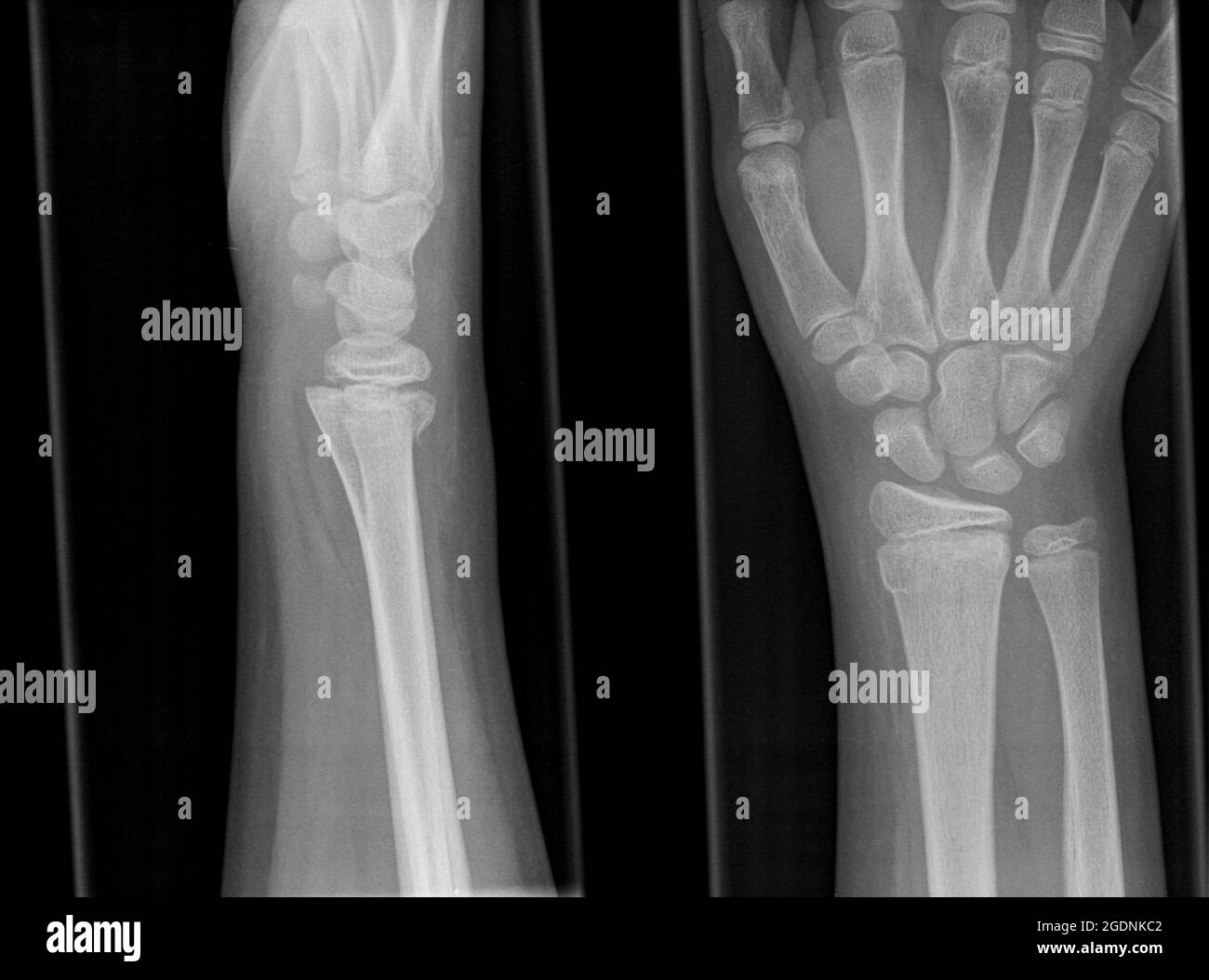 Distale Radius X ray showing distal radius fracture Schwarzweiß-Stockfotos und -bilder ...