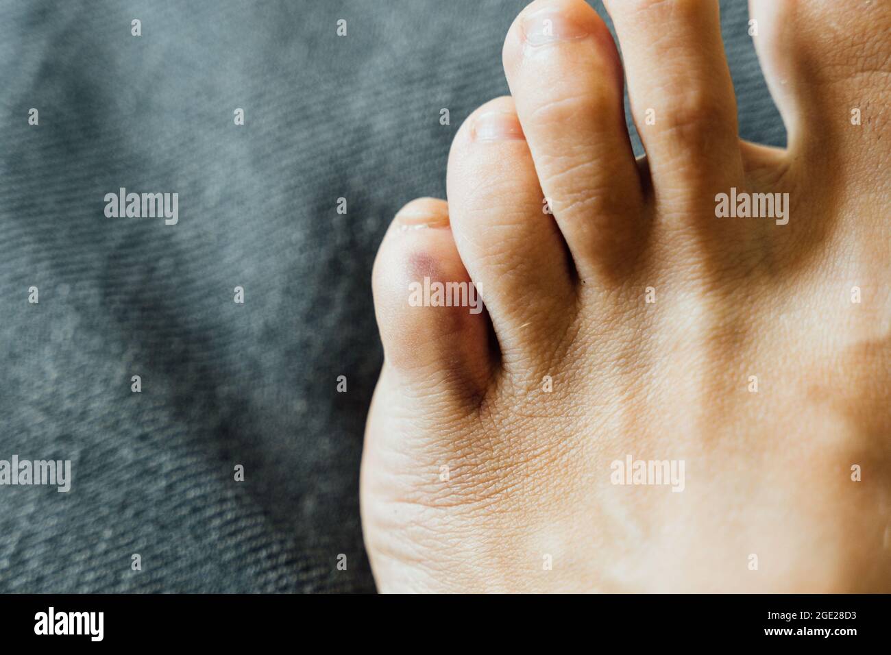 Fußverletzung mit kleinen Fingern. Kleine Zehen Schmerzen und Blutergüsse nach Hausunfall. Fraktur des Kluftbeins. Barfuß Fingernägel gesund. Stockfoto