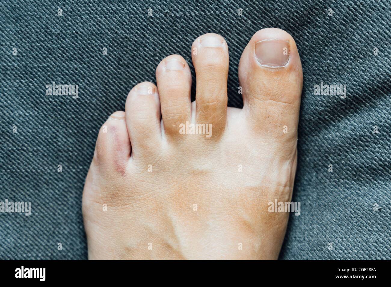 Fußverletzung mit kleinen Fingern. Kleine Zehen Schmerzen und Blutergüsse nach Hausunfall. Fraktur des Kluftbeins. Barfuß Fingernägel gesund. Stockfoto