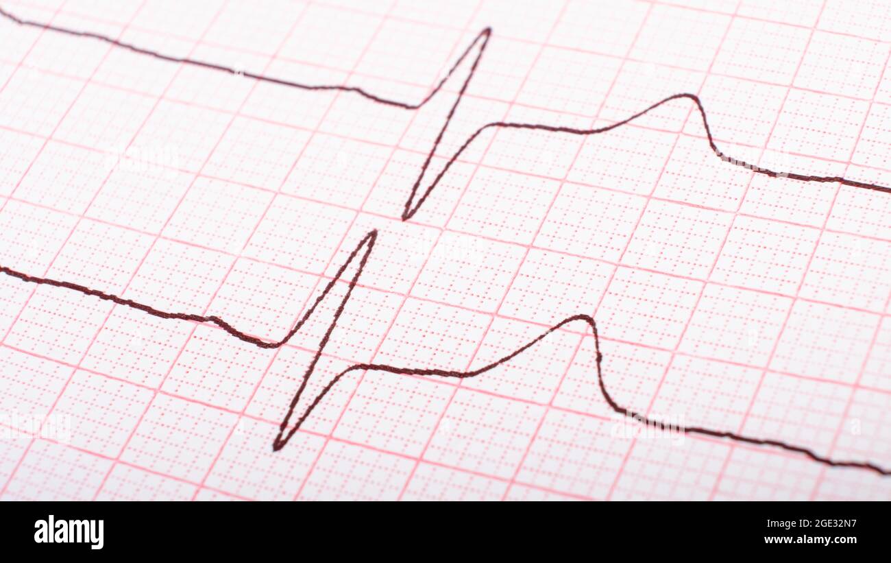 Kardiogramm der Herzimpulse, hypertonisches Krankheitskonzept. Stockfoto