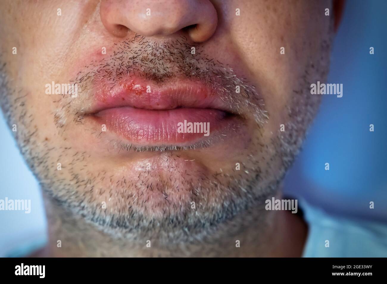 Oral herpes Stockfotos und -bilder Kaufen - Alamy