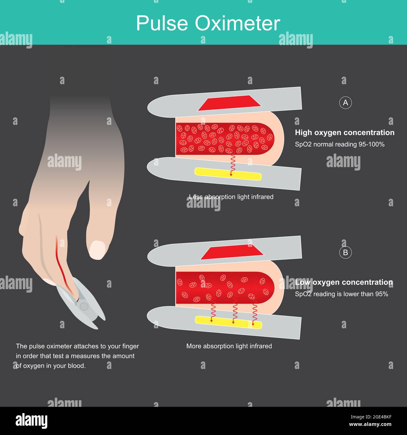 Pulsoximeter. Illustration zum Lernen eines medizinischen Geräts, das zur Messung der Sauerstoffsättigung im Blutgefäß vom Fingerspitzen aus verwendet wird. Stock Vektor