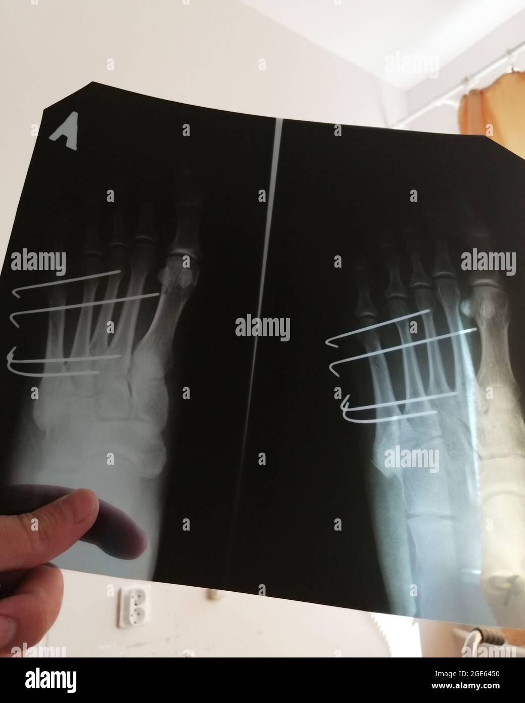 Orthopädische Chirurgie des menschlichen Fußes auf Röntgen. PIN-Osteosynthese. Stockfoto