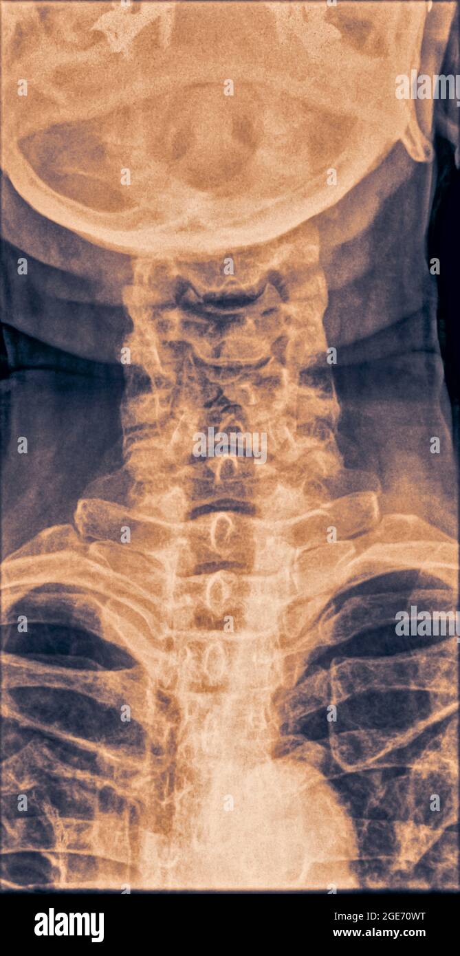 Normale Röntgenaufnahme der Halswirbelsäule einer 70-jährigen Patientin. Vorderansicht Stockfoto