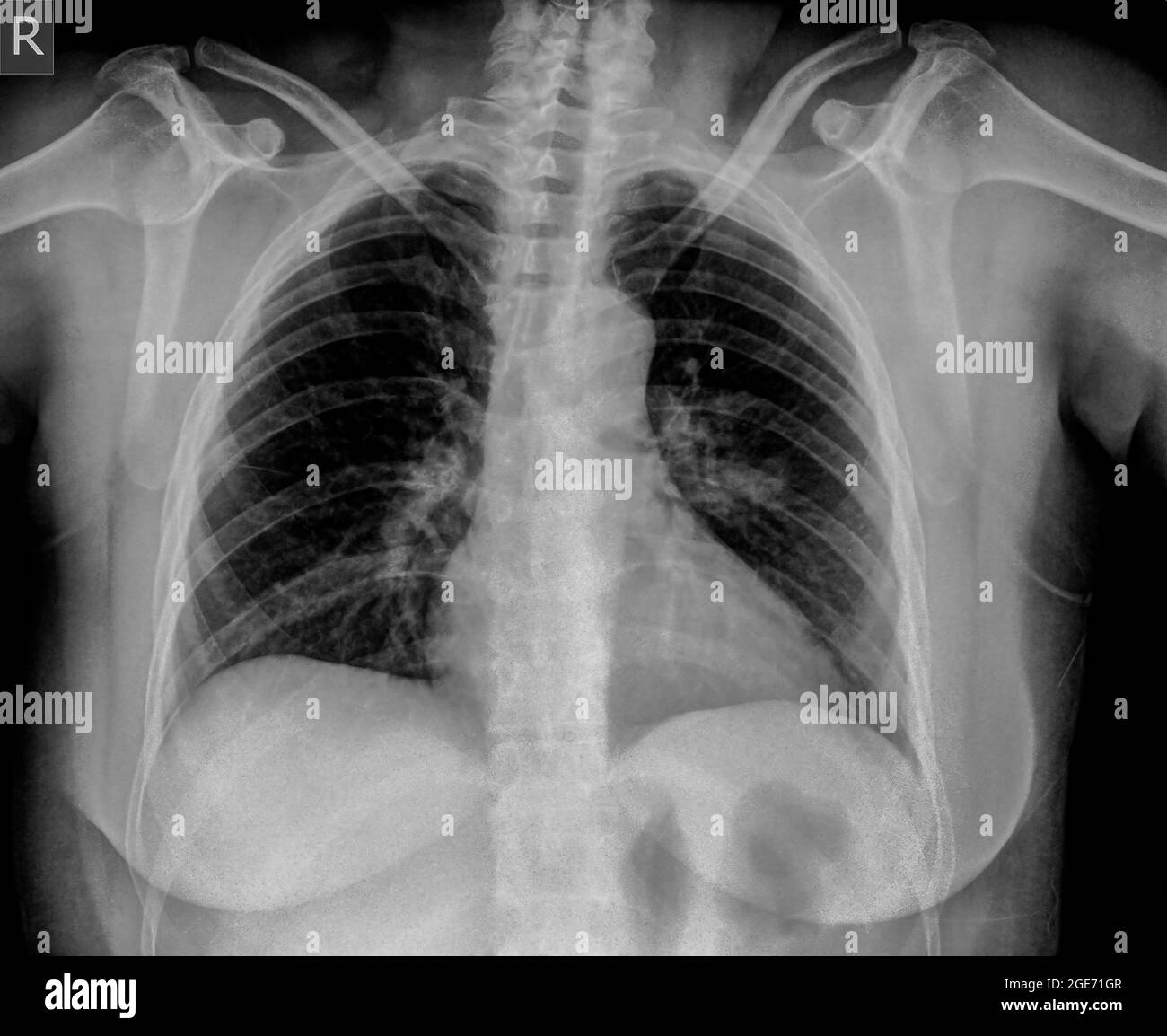 Thorax-Röntgenaufnahme einer einjährigen Frau mit Lungenentzündung. Vorderansicht Stockfoto