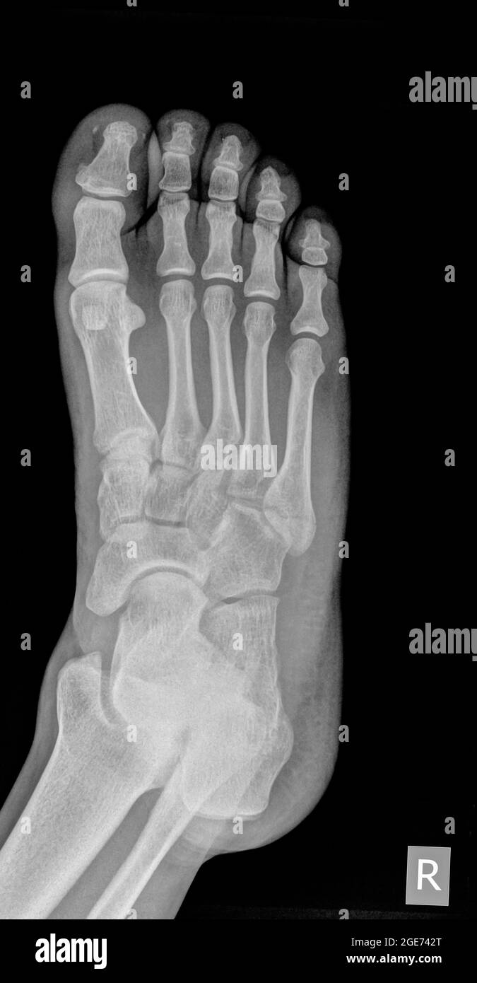Röntgenbild eines Fußes zeigt eine Fraktur in der 5. Metatarsalia ein 31 Jahre alter Mann Stockfoto