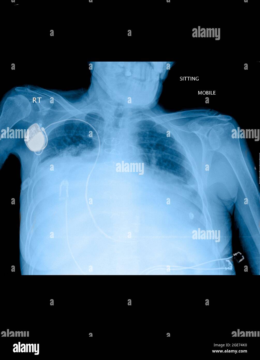 Thorax-Röntgenaufnahme einer 71-jährigen Patientin mit Dyspnoe Stockfoto