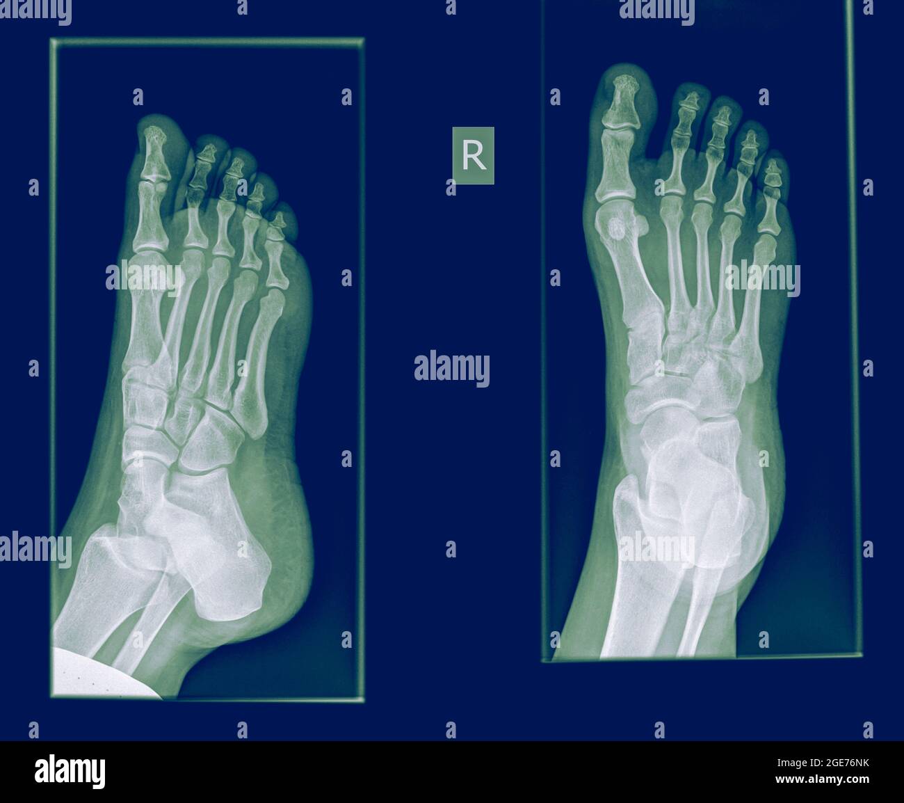 X-ray von einem Fuß einen Bruch in der proximalen Phalanx der Großzehe auf dem righ Fuß einer 30 Jahre alten Patientin Stockfoto