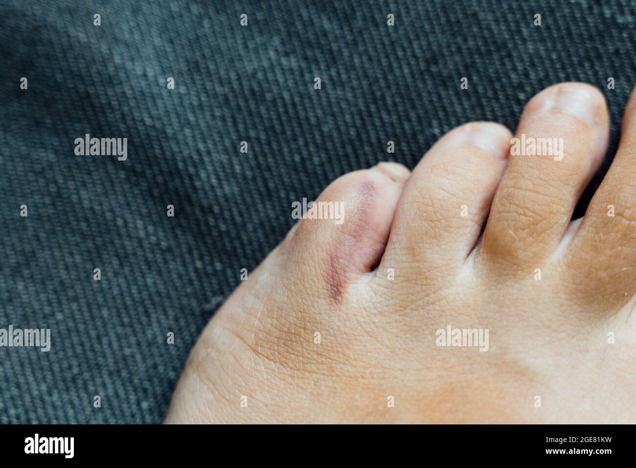 Fußverletzung mit kleinen Fingern. Kleine Zehen Schmerzen und Blutergüsse nach Hausunfall. Fraktur des Kluftbeins. Barfuß Fingernägel gesund. Stockfoto