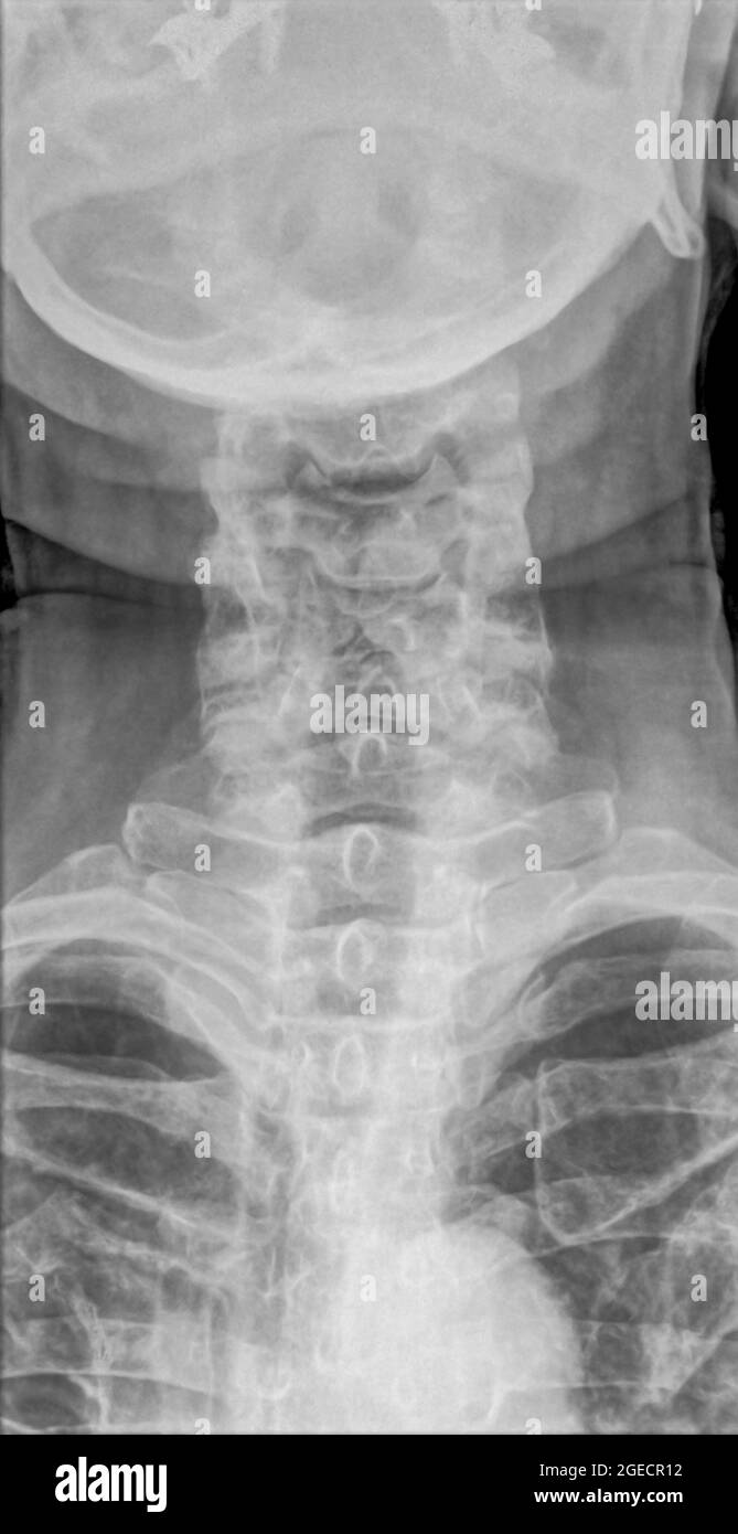 Normale Röntgenaufnahme der Halswirbelsäule einer 70-jährigen Patientin. Vorderansicht Stockfoto