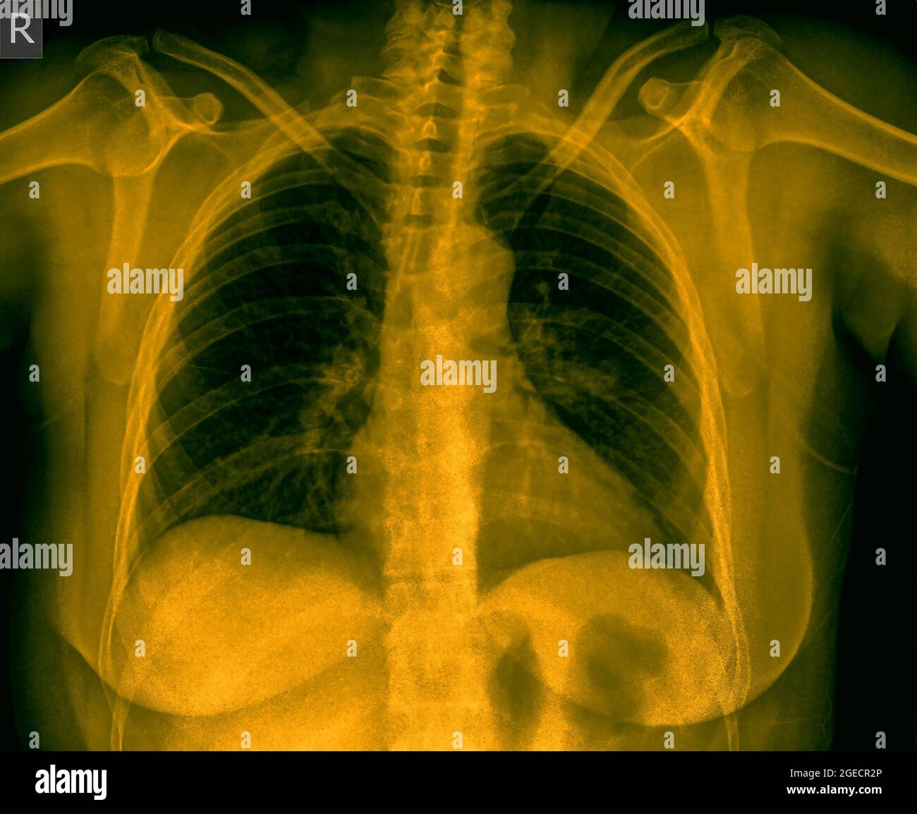 Thorax-Röntgenaufnahme einer einjährigen Frau mit Lungenentzündung. Vorderansicht Stockfoto