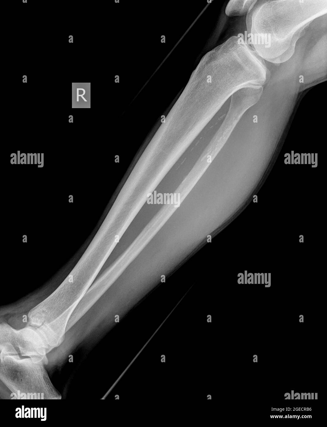 Röntgenaufnahme des 50 Jahre alten Mannes mit Unterschenkel und gebrochener Tibia von vorne Stockfoto